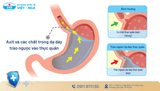 Trào ngược dạ dày