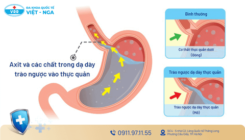Trào ngược dạ dày
