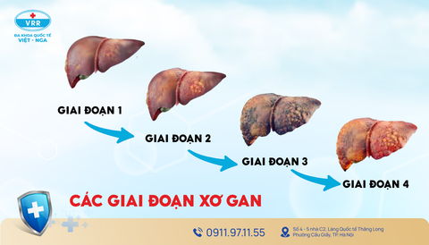 Xơ gan có nguy hiểm không? Hiểu đúng để bảo vệ lá gan của bạn