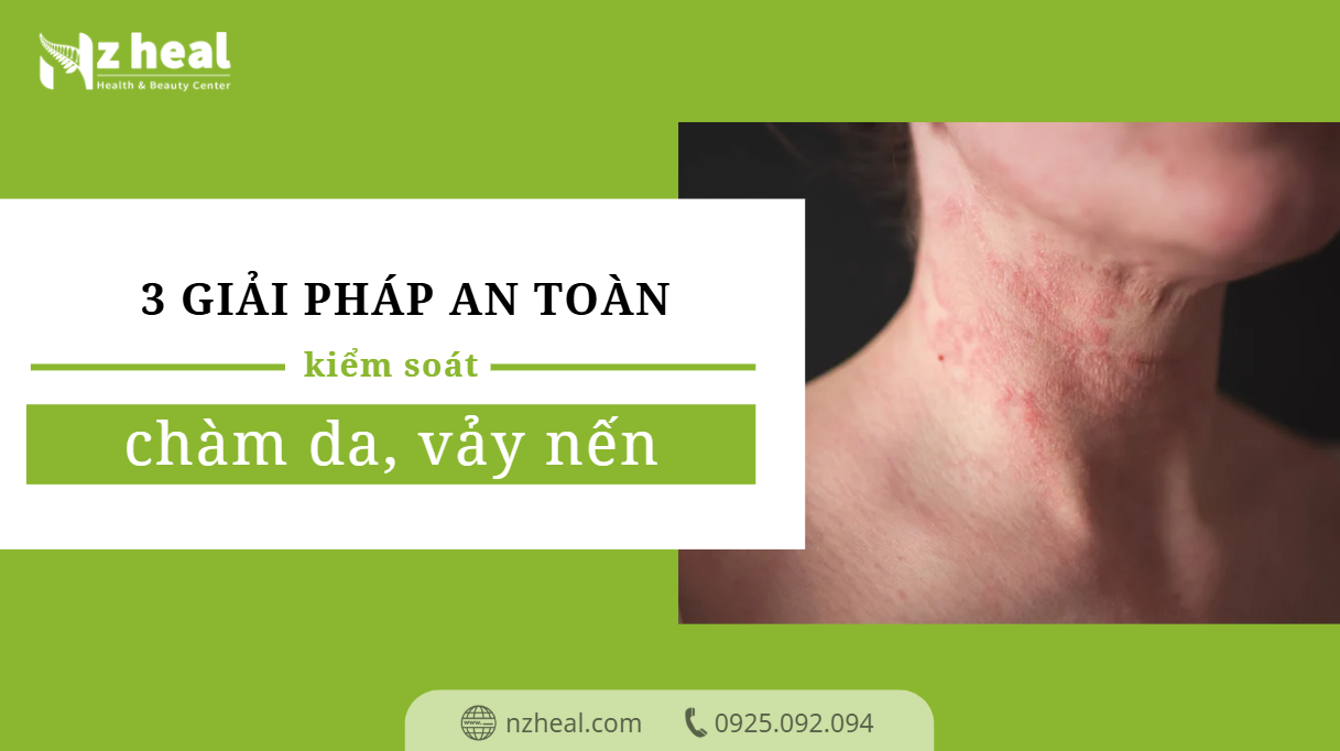 3 giải pháp an toàn kiểm soát chàm da, vảy nến