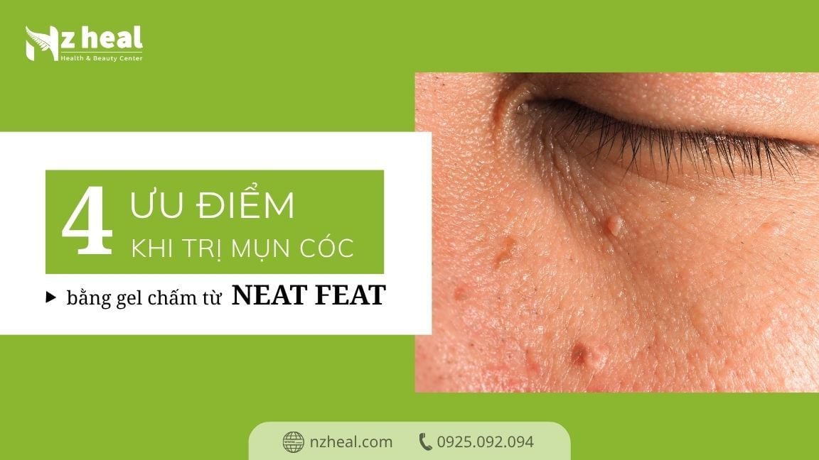 4 ưu điểm của phương pháp trị mụn cóc bằng gel chấm từ Neat Feat