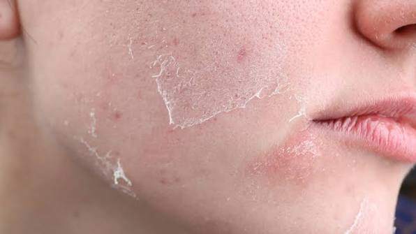 CÁCH PHÂN BIỆT DA KHÔ VÀ DA THIẾU NƯỚC - HIỂU ĐÚNG ĐỂ CHĂM SÓC ĐÚNG