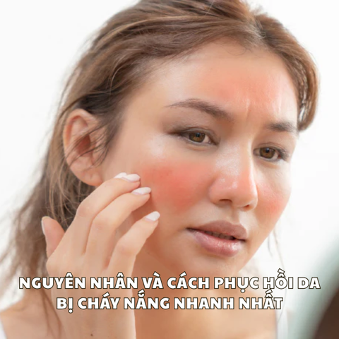 NGUYÊN NHÂN VÀ CÁCH PHỤC HỒI DA BỊ CHÁY NẮNG NHANH NHẤT