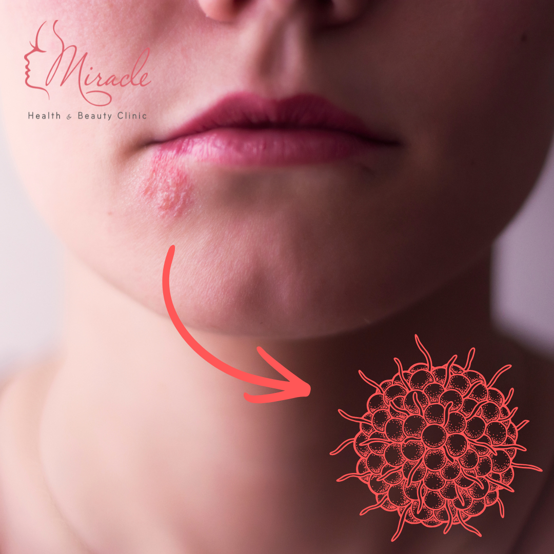 CÂU HỎI THƯỜNG GẶP VỀ BỆNH ZONA