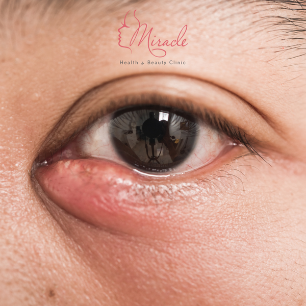 PHÂN BIỆT LẸO MẮT VÀ CHẮP MẮT