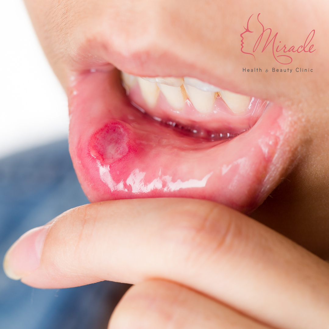 LOÉT MIỆNG LÀ GÌ?