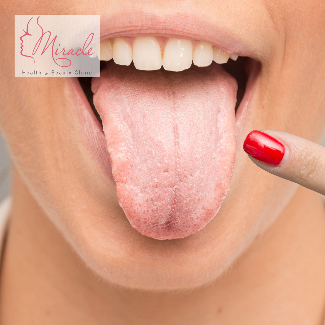 CÁCH PHÒNG BỆNH TƯA MIỆNG