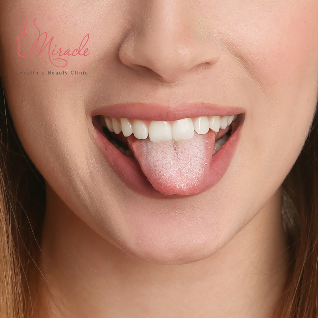 BỆNH TƯA MIỆNG LÀ GÌ?