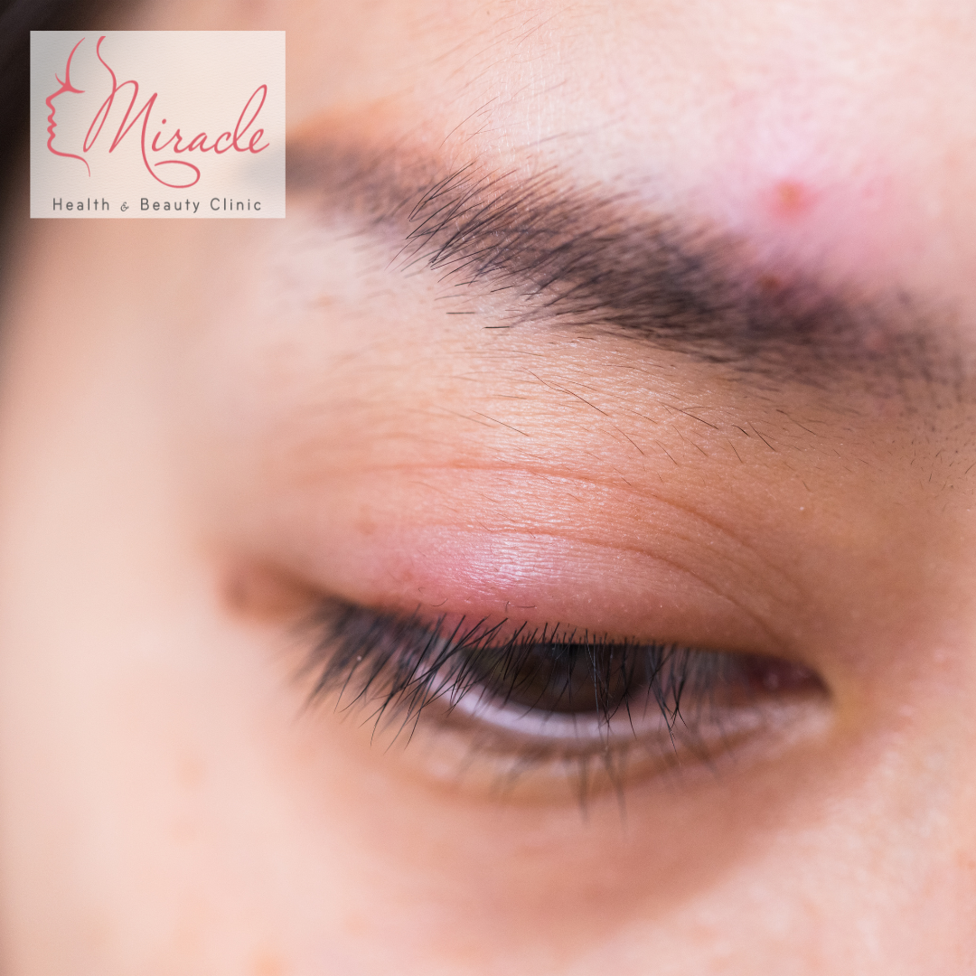 PHÒNG NGỪA LẸO MẮT