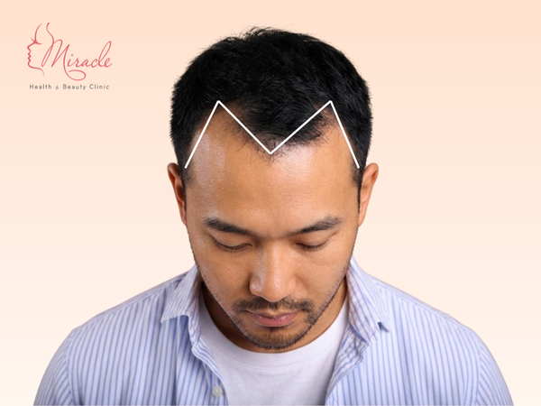 HÓI CHỮ M CHỮA THẾ NÀO?
