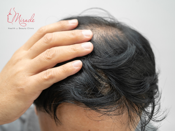 CÁCH TRỊ HÓI ĐẦU Ở NAM GIỚI