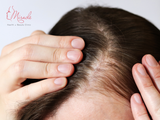 CÁCH TRỊ HÓI ĐẦU Ở NỮ GIỚI?