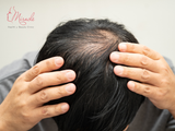 CÁCH TRỊ HÓI ĐỈNH ĐẦU?