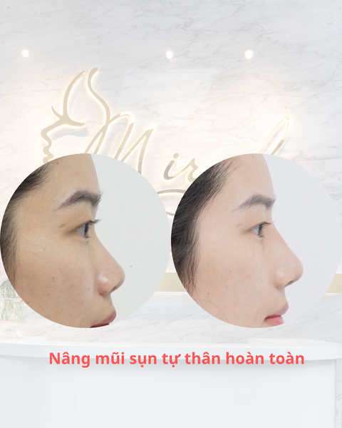 Tối ưu hóa sụn vách ngăn trong nâng mũi Châu Á: Giải pháp an toàn từ CT Scan