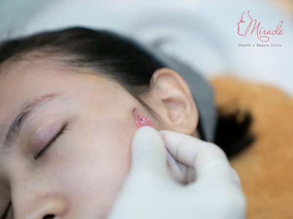 CĂNG CHỈ DA MẶT GIÁ BAO NHIÊU?