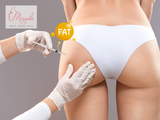 Nâng Mông Bằng Mỡ Tự Thân