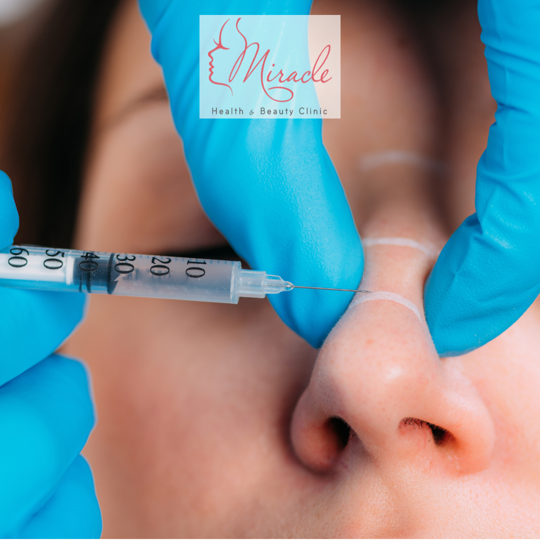 Nâng Mũi Không Phẫu Thuật