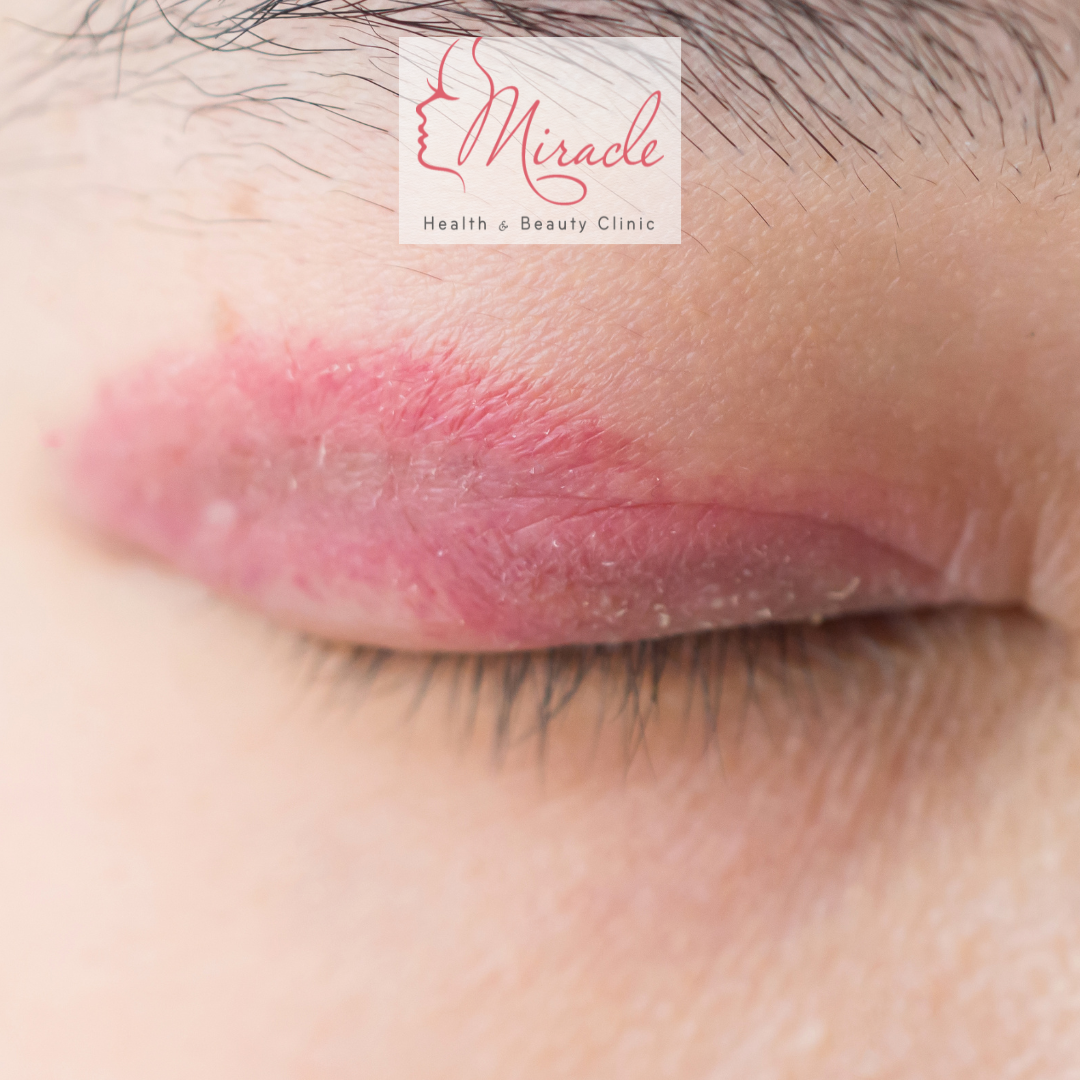 Biến Chứng Cắt Mí