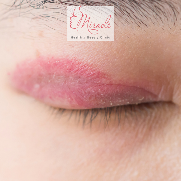 Biến Chứng Cắt Mí