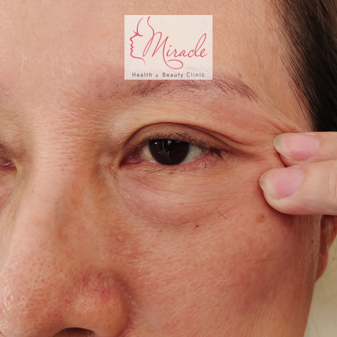 Cắt Bọng Mỡ Mắt Mi Dưới Có Nên Không?