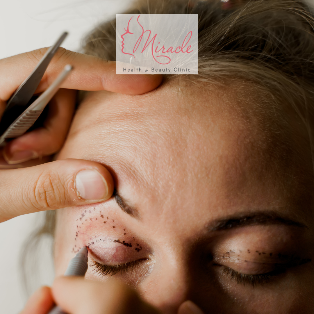 Cắt Da Thừa Mí Mắt Trên