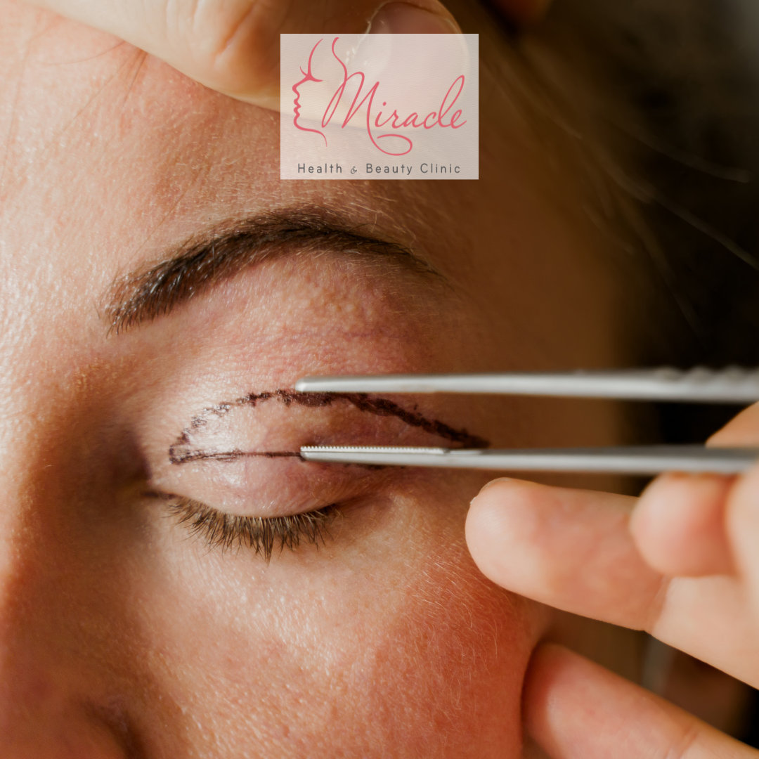 Cắt Da Thừa Mí Mắt Trên Bao Nhiêu Tiền?