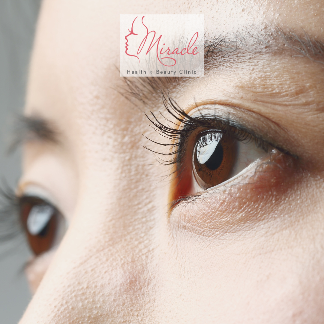 Cắt Mỡ Mí Mắt Trên