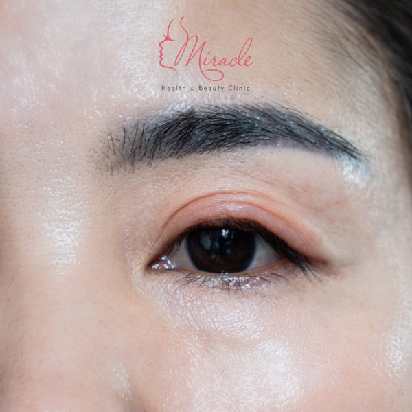 Sụp Mi Mắt: Nguyên Nhân Và Cách Điều Trị