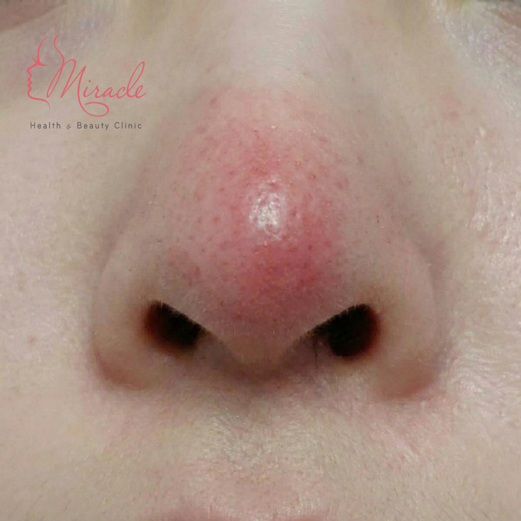 MŨI BỊ BÓNG ĐỎ