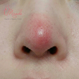 MŨI BỊ BÓNG ĐỎ