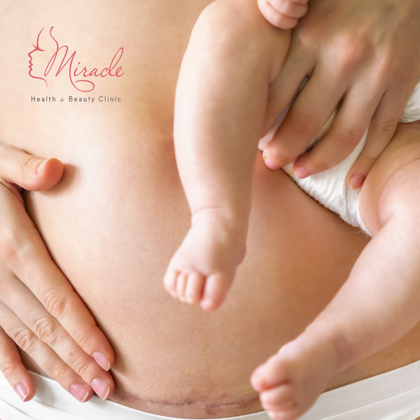 SỨC KHỎE VÙNG CHẬU SAU SINH MỔ