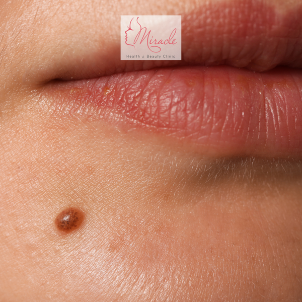 Xóa Nốt Ruồi Bằng Laser Giá Bao Nhiêu