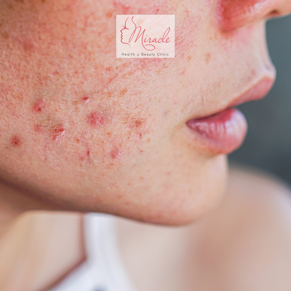 Trị Mụn Bằng Laser Có Hiệu Quả Không?