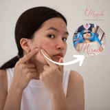 Trị Mụn Bằng Laser Giá Bao Nhiêu?