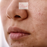 Trị Sẹo Bằng Laser Có Hiệu Quả Không?