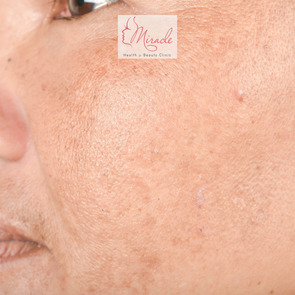 Trị Nám Bằng Laser Có Hiệu Quả Không?