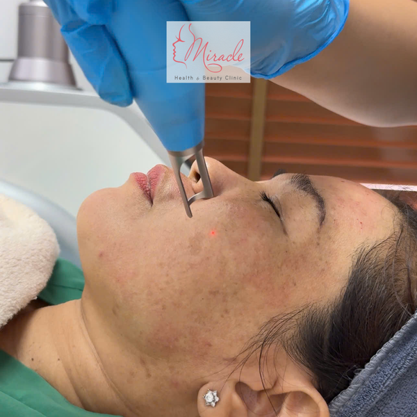 Trị Nám Bằng Laser Bao Nhiêu Tiền?