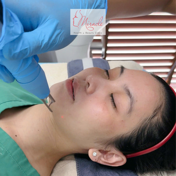 Trị Tàn Nhang Bằng Laser Có Hiệu Quả Không?