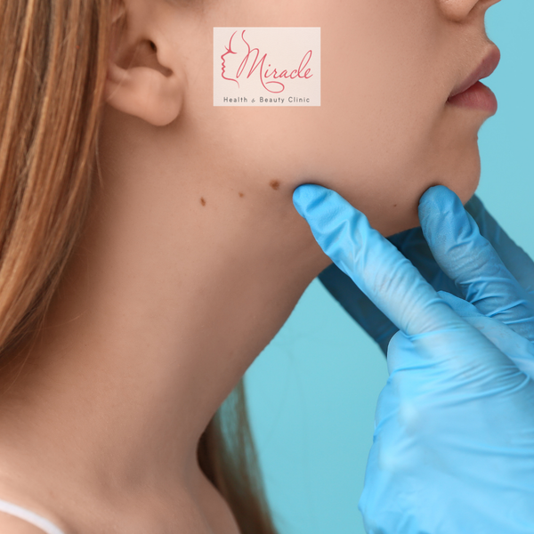 Bắn Laser Trị Tàn Nhang Giá Bao Nhiêu?