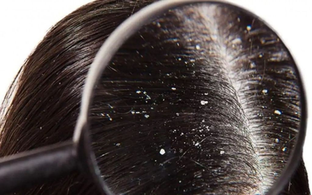 Da đầu nhiều gàu phải làm sao?