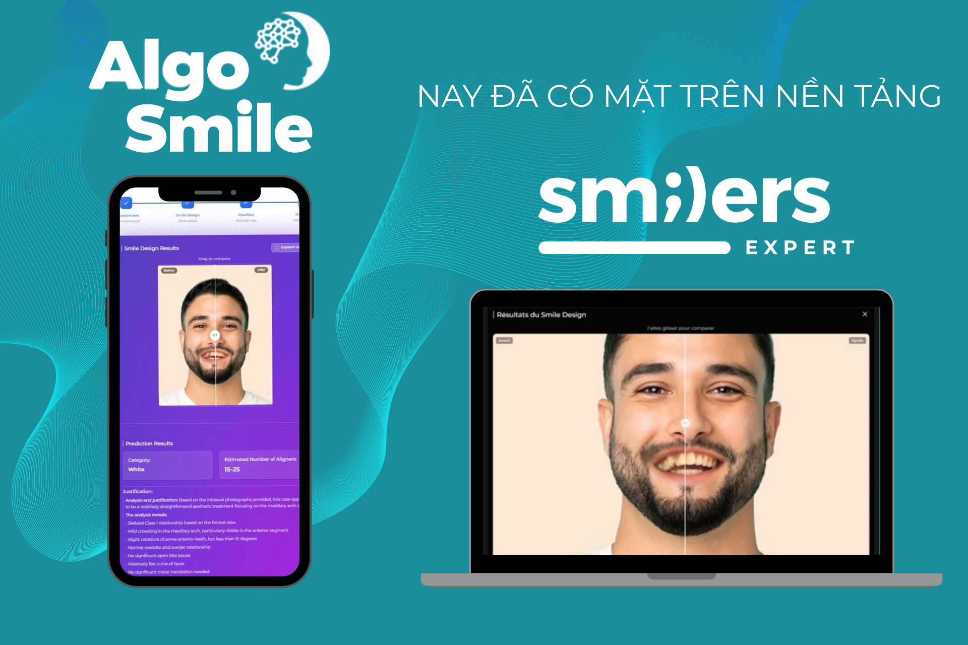 ĐIỀU TRỊ CHỈNH NHA HIỆU QUẢ HƠN CÙNG TÍCH HỢP AI ALGOSMILE TRÊN SMILERS EXPERT