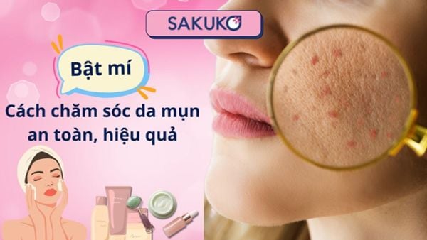 Bật mí cách chăm sóc da mụn an toàn, hiệu quả
