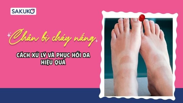 Chân bị cháy nắng phải làm sao? Cách xử lý và phục hồi da hiệu quả