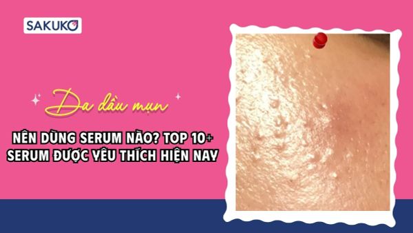 Da dầu mụn nên dùng serum nào? Top 10 serum trị mụn đang được yêu thích