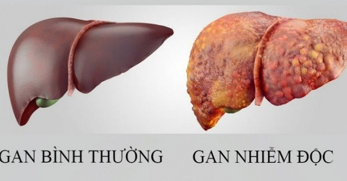 Hỗ trợ giải độc gan toàn diện