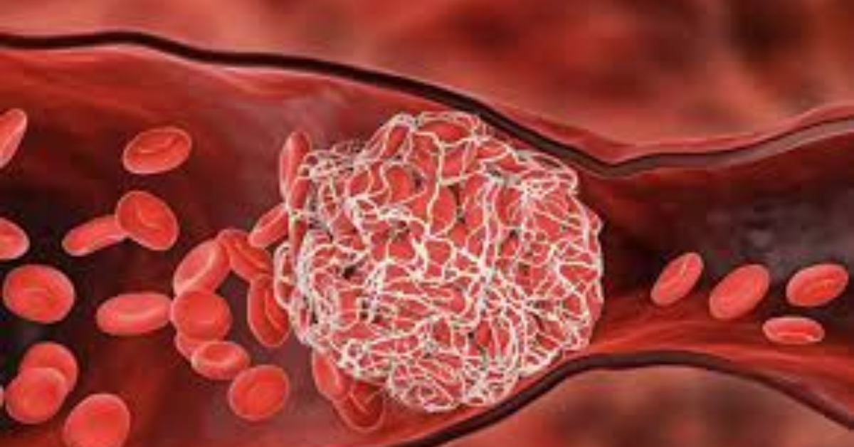 Hỗ trợ làm tan cục máu đông, ngăn ngừa tắc nghẽn mạch máu