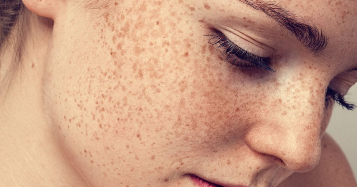 Hỗ trợ làm trắng da, mờ thâm nám, tàn nhang