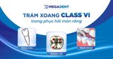 Trám xoang Class VI trong phục hồi mòn răng: Định nghĩa, quy trình và vật liệu cần thiết