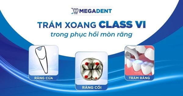 Trám xoang Class VI trong phục hồi mòn răng: Định nghĩa, quy trình và vật liệu cần thiết