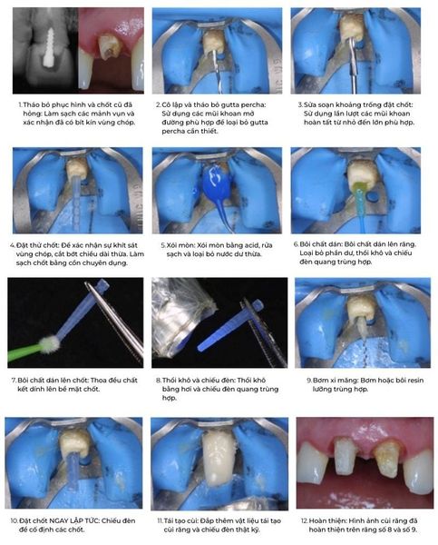 Chốt sợi thủy tinh Macro-Lock Post Illusion X-RO 2